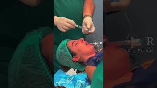 Anesthesia for Rhinoplasty Cosmetic Surgery - Intubation - General Anaesthetic 👃🏻Sleep &amp; Recovery