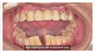 Cleaning Dried Mucus and Phlegm from Your Loved Ones Teeth