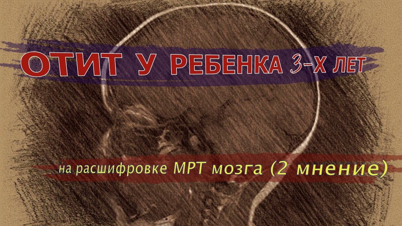 КИСТА эпифиза, двухсторонний МАСТОИДИТ и ОТИТ у ребенка на РАСШИФРОВКЕ ...