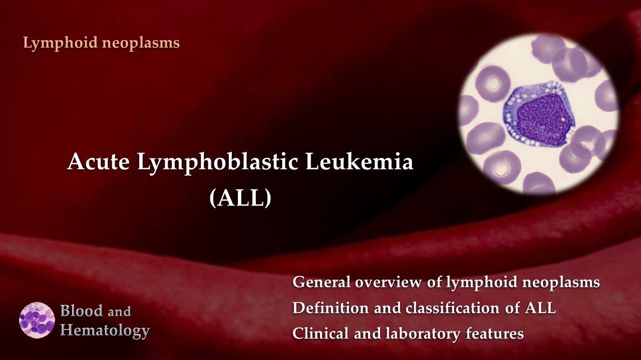 Acute Lymphoblastic Leukemia  (ALL)