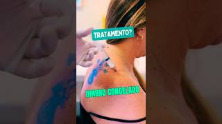 Ombro Congelado Qual O Tratamento tendinite manguitorotador ombrocongelado capsulite
