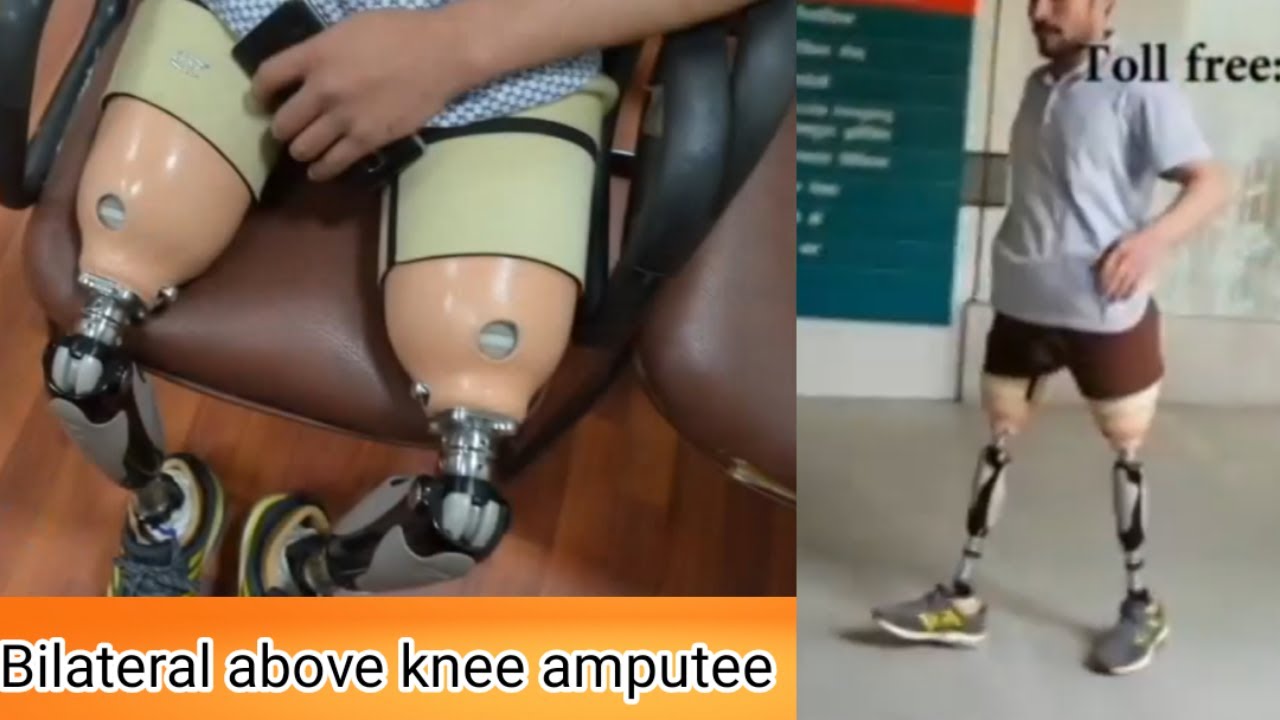 bilateral above knee amputee leg #Artificiallimb @pointernationalprivatelimi3612