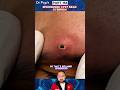 “This Looks Dangerous… But It’s an Epidermoid Cyst 😳 #Shortsfeed #Shorts
