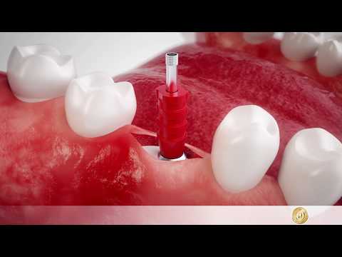 Video: Was passiert während der Implantation?