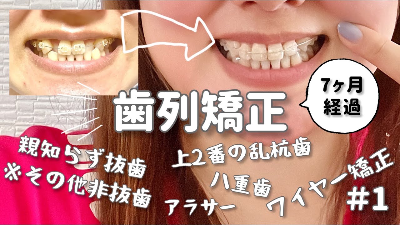 【矯正日記#1】装着初日から7ヶ月間の変化