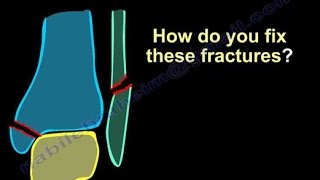 Ankle Fractures, Surgical Treatment ,tactics - Everything You Need To Know - Dr. Nabil Ebraheim