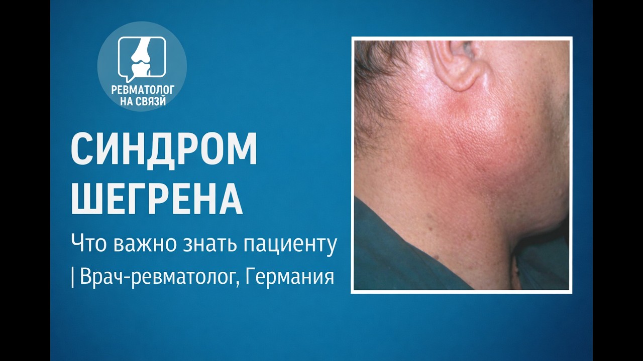Синдром Шегрена: что скрывается за сухостью глаз и рта?