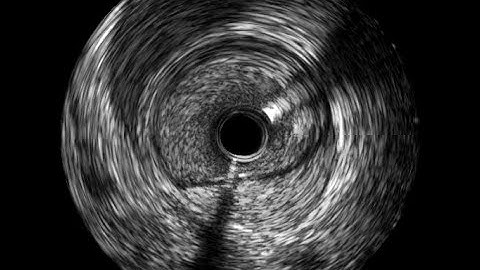 coronary intramural hematoma