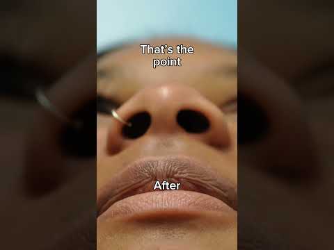Alarplasty Before & after transformation - Dr.tanveer Janjua
