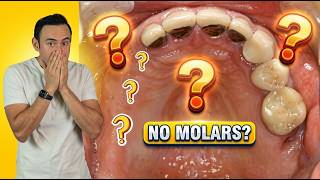 This Happens to Your Body When You Lose Teeth | The Truth Will Shock You