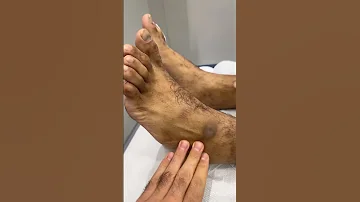 تنميل القدم بسبب التهاب الاعصاب الطرفيه لناس الي تعاني من السكر 