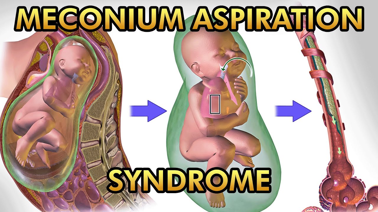 Meconium Aspiration Syndrome: Pathophysiology, Signs and Symptoms, Diagnosis and Treatment