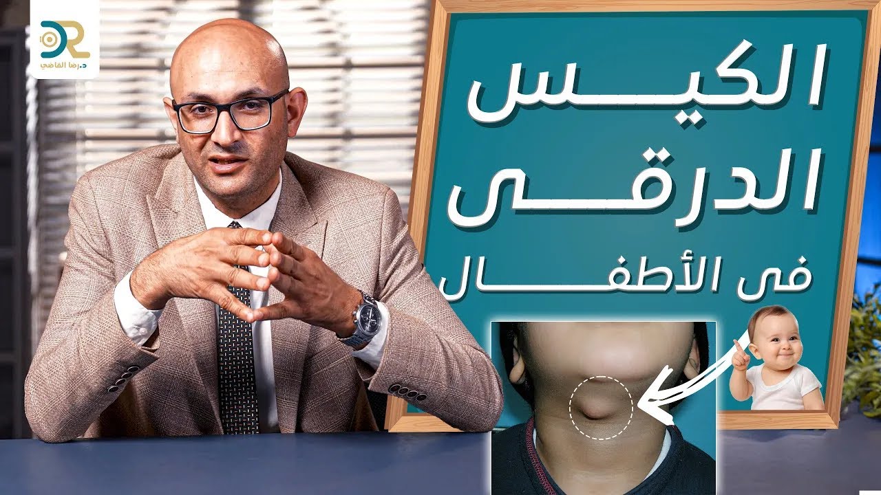 علاج الكيس الدرقي عند الاطفال | دكتور رضا القاضي #الكيس_الدرقي