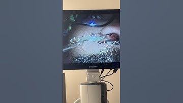 Satisfying booger extraction. #reddysinus