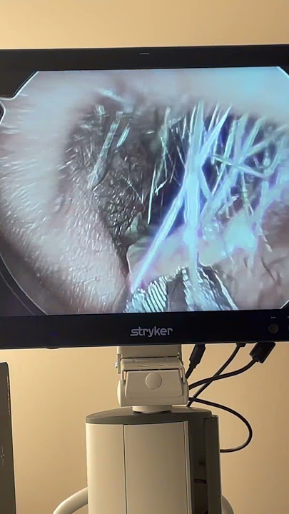 Satisfying booger extraction. #reddysinus