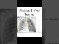 Easy to Miss - Tracheal Deviation on a Chest X-ray