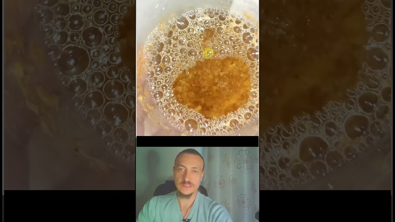 Как сода борется с грибком в организме #грибок #здоровье #кандида #подмикроскопом