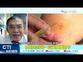 【每日必看】診所打錯針"看錯姓名" 醫師示警:用別人血液恐感染 20260701