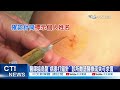 【每日必看】診所打錯針"看錯姓名" 醫師示警:用別人血液恐感染 20260701