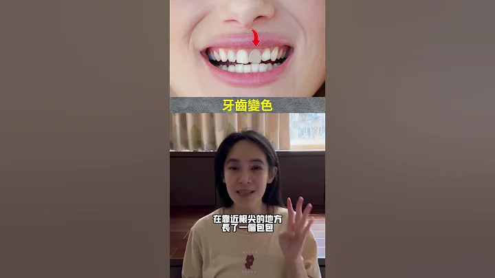有下面四個症狀請快去看牙醫＃活髓保存術＃根管治療 - 天天要聞
