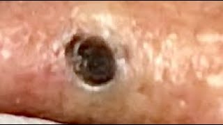 Big blackhead