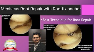 Medial Meniscus Root Repair with Root Fix anchor.