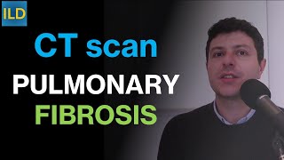 Is a CT scan necessary to detect Pulmonary Fibrosis