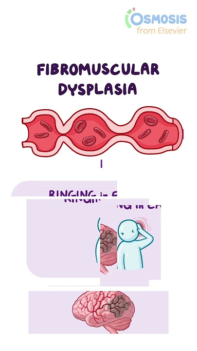 Fibromuscular Dysplasia