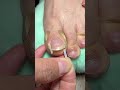 Toe Nail Fixer| Ingrown Toenail Cleaning & Care #ToenailFix #NailCare #FootCare #PedicureClean