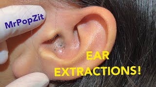 EAR EXTRACTIONS! Must see giant ear blackheads extracted.