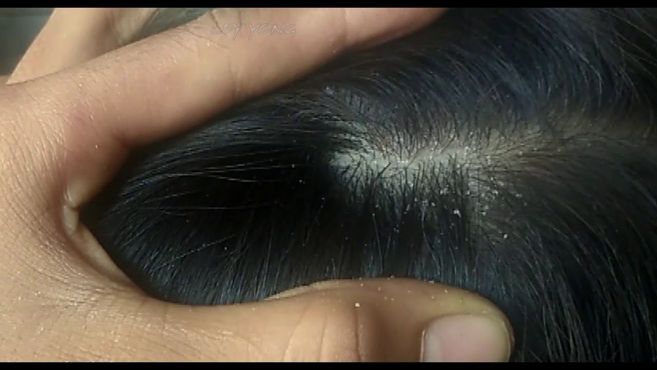 Dandruff Scratching Treatment Dandruff Scratching With Lice Comb