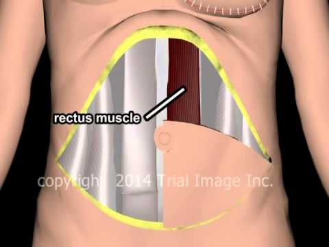 Breast Reconstruction (TRAM) - animation & narration by Cal Shipley, M.D.