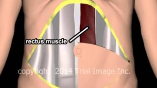 Breast Reconstruction (TRAM) - animation & narration by Cal Shipley, M.D.