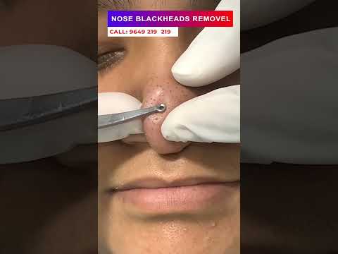 Nose blackheads removal at skinaa clinic | Viral #shorts