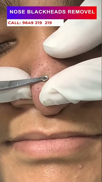 Nose blackheads removal at skinaa clinic | Viral #shorts