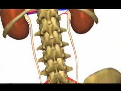 Kidney Stones: A Sign of Something Worse? (Dramati...