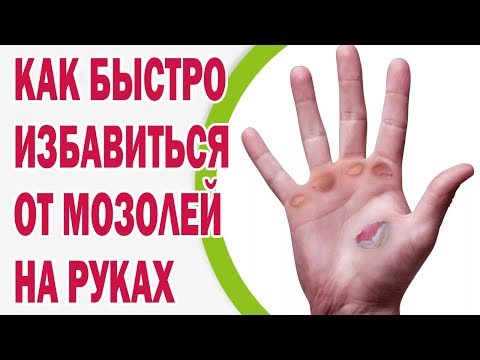 Как убрать мозоли на руках в домашних условиях