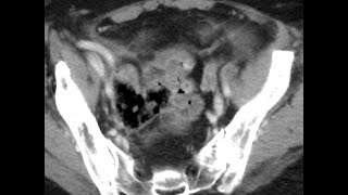 Rectal perforation @yaleradiology