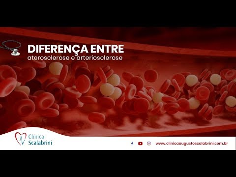 Vídeo: Diferença Entre Ateroma E Aterosclerose
