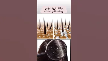 أسباب قشرة الشعر 