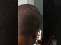 WATCH THIS🚨👀 -I HAVE A BALD SPOT - Alopecia Areata After Locs😱🤯 #dreadlockjourney