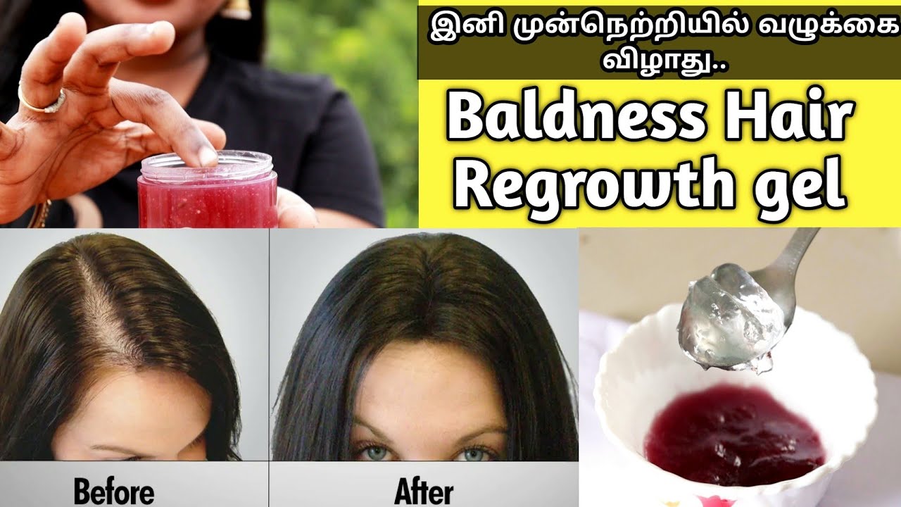 இது போதும் முன் நெற்றியில் வழுக்கை வராது ❤️❤️| Baldness regrowth hair gel |#Jegathees_meena
