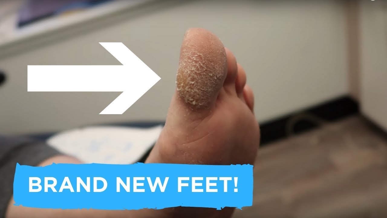 BRAND NEW FEET - CALLUS AND NAIL CARE! matthew doyle linkedin