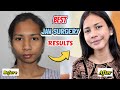 Best Jaw Surgery Before &amp; After Results | Underbite, Overbite, Facial Asymmetry, OSA, Genioplasty