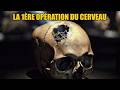 LA 1ERE OPERATION DU CERVEAU . 💀