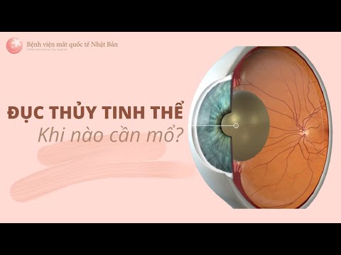 ĐỤC THỦY TINH THỂ, khi nào cần mổ? | Bệnh viện mắt quốc tế Nhật Bản