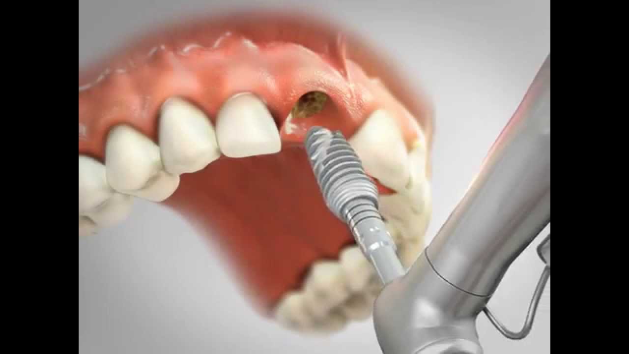 Implantes dentários Clínica Odontowicz - YouTube