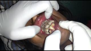 Oral Myiasis screenshot 1