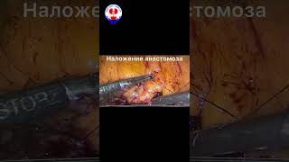 Лапароскопическая пластика ЛМС #урология #доктор #ташкент #doctor #уролог