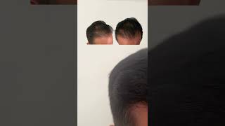 1 year follow up ⚡️ 2K Grafts⁠⁠microFUE Hair Transplant⁠ ⚡️⁠